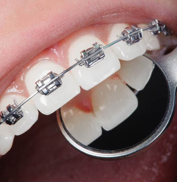 Braces Treatment